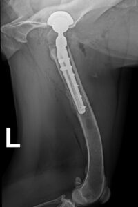 Unmittelbar nach der OP: Die neue Titanhüfte ist stabil im Knochen verschraubt.