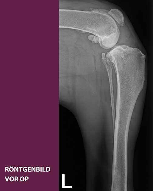 Röntgenbild TPLO bei Dogge - Kreuzbandriss vorOP