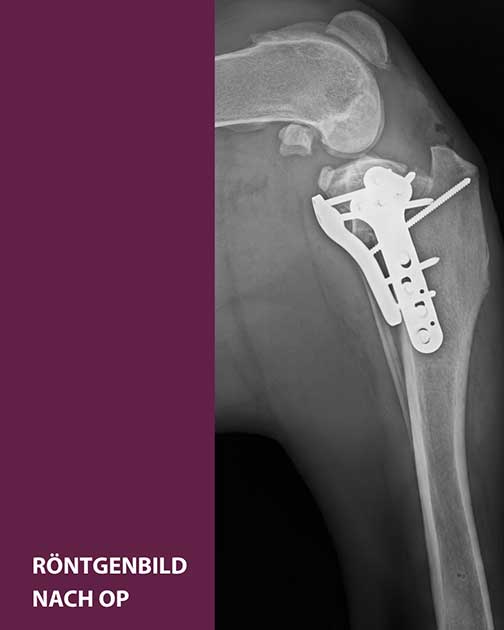 Röntgenbild TPLO bei Dogge - Kreuzbandriss nach OP