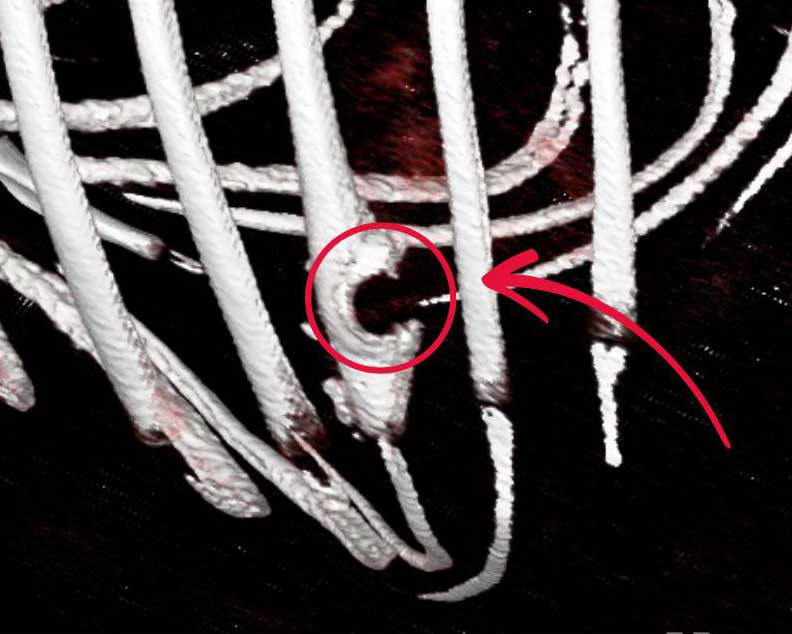 In der 3-D-Darstellung des CTs ist die Beschädigung der Rippe gut zu erkennen.