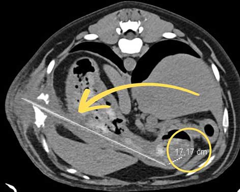 Ein rund 17 Zentimeter langer Holzspieß hatte sich durch die Magenwand gebohrt und war weiter durch die Bauchwand gewandert.