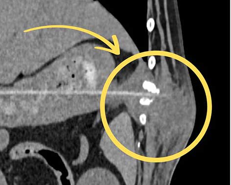 An einer betroffenen Rippe zeigten sich dadurch bereits beginnende Auflösungserscheinungen. CT Tierklinik Ismaning.