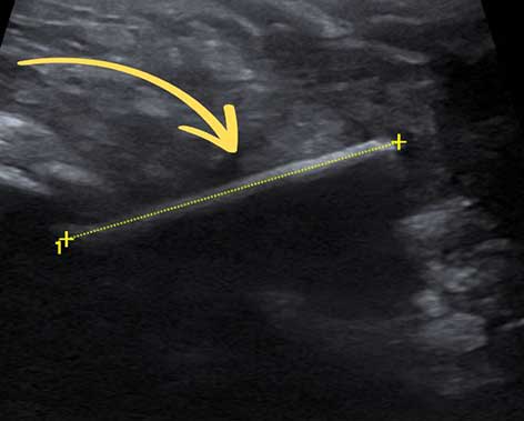 Im Ultraschall: Auslöser der Schwellung: ein deutlich sichtbarer, länglicher Fremdkörper.